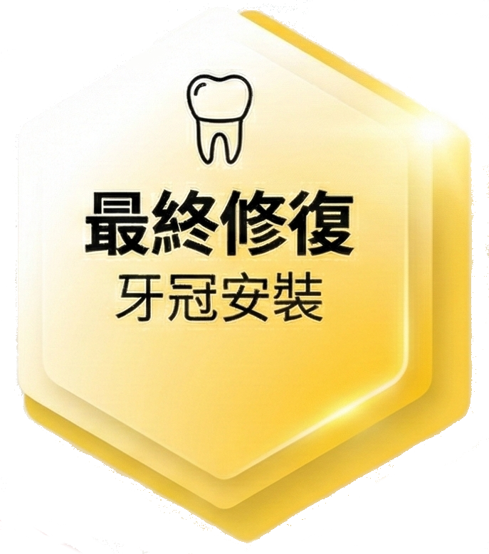最終修復牙冠安裝