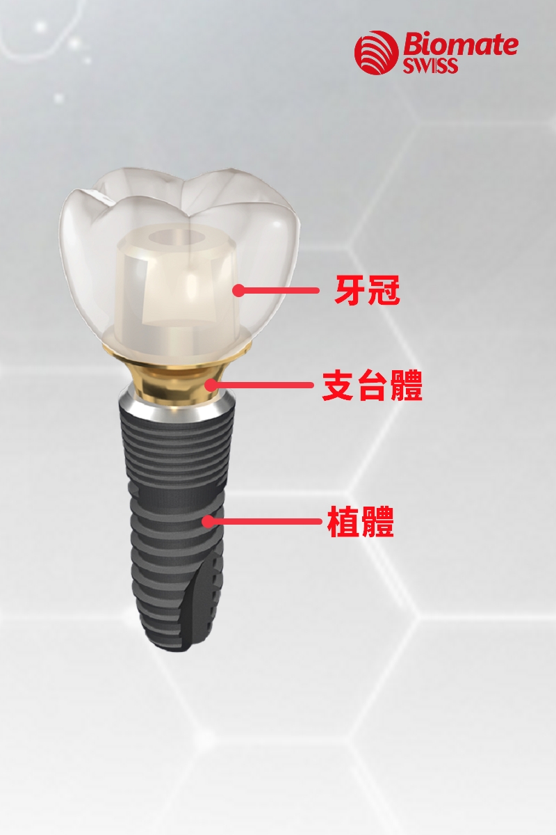 人工牙根